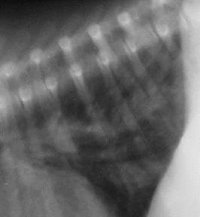Radiografia del torace di un paziente con dotto arterioso pervio <br />