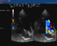 flusso turbolento attraverso il dotto pervio