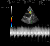 flusso turbolento attraverso il dotto pervio